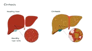 LIVER cirrhosis