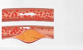 Lipid Profile Test for Cholesterol